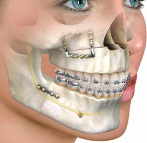 جراحی فک ارتوگناتیک : همه آنچه باید بدانید